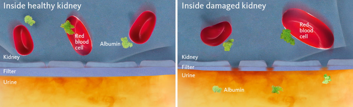 [.DK-dk Denmark (danish)] •	Schematic and simplified view of a healthy and a damaged kidney membrane with the latter illustrating the cause of albuminuria.