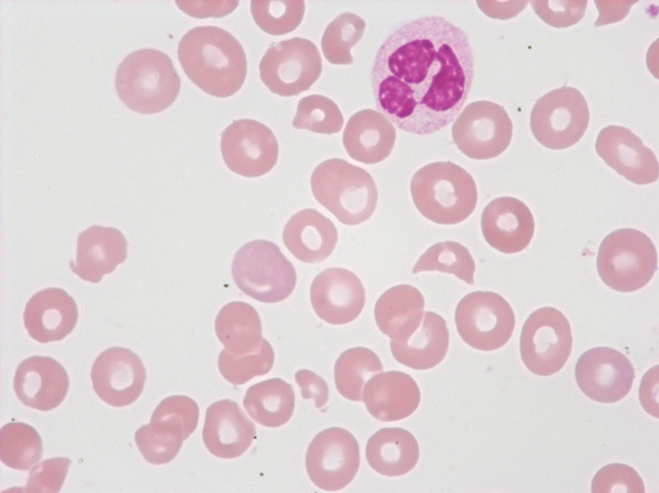 Fragmented red blood cells and thrombocytopenia