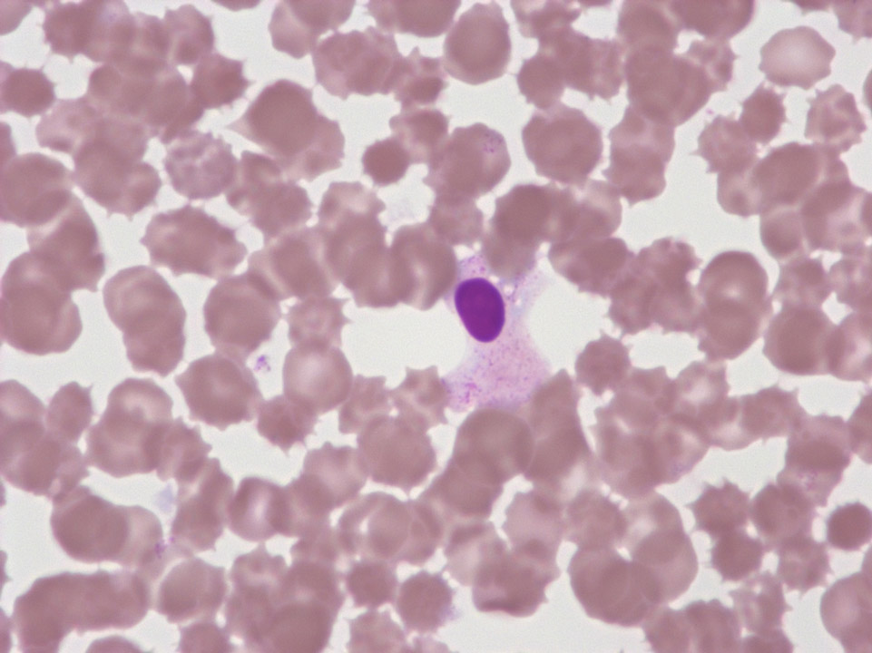Degraded granulocytes