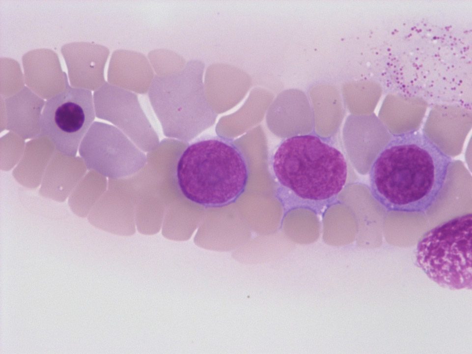Breast carcinoma cells on blood film Breast carcinoma cells on blood film