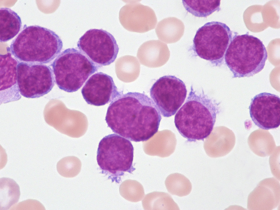 Hairy cell leukaemia-variant