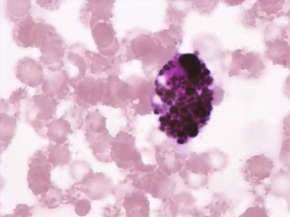 Tumour cells from malignant melanoma