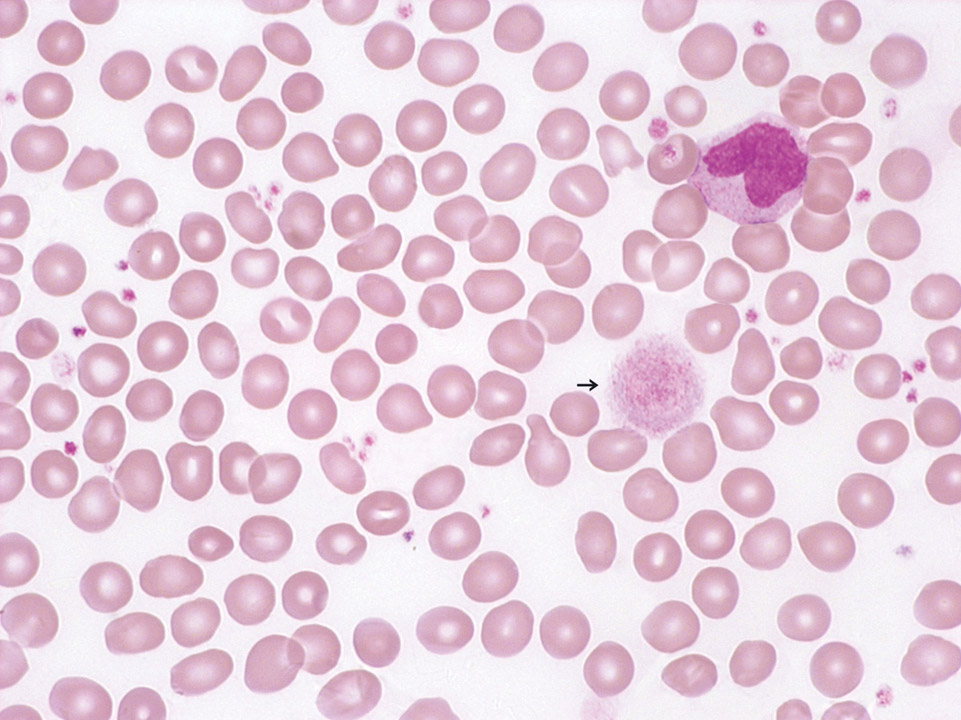 Giant platelets in peripheral blood