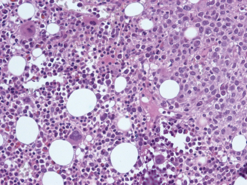 Bone marrow infiltrated by a diffuse large B-cell lymphoma Bone marrow infiltrated by a diffuse large B-cell lymphoma