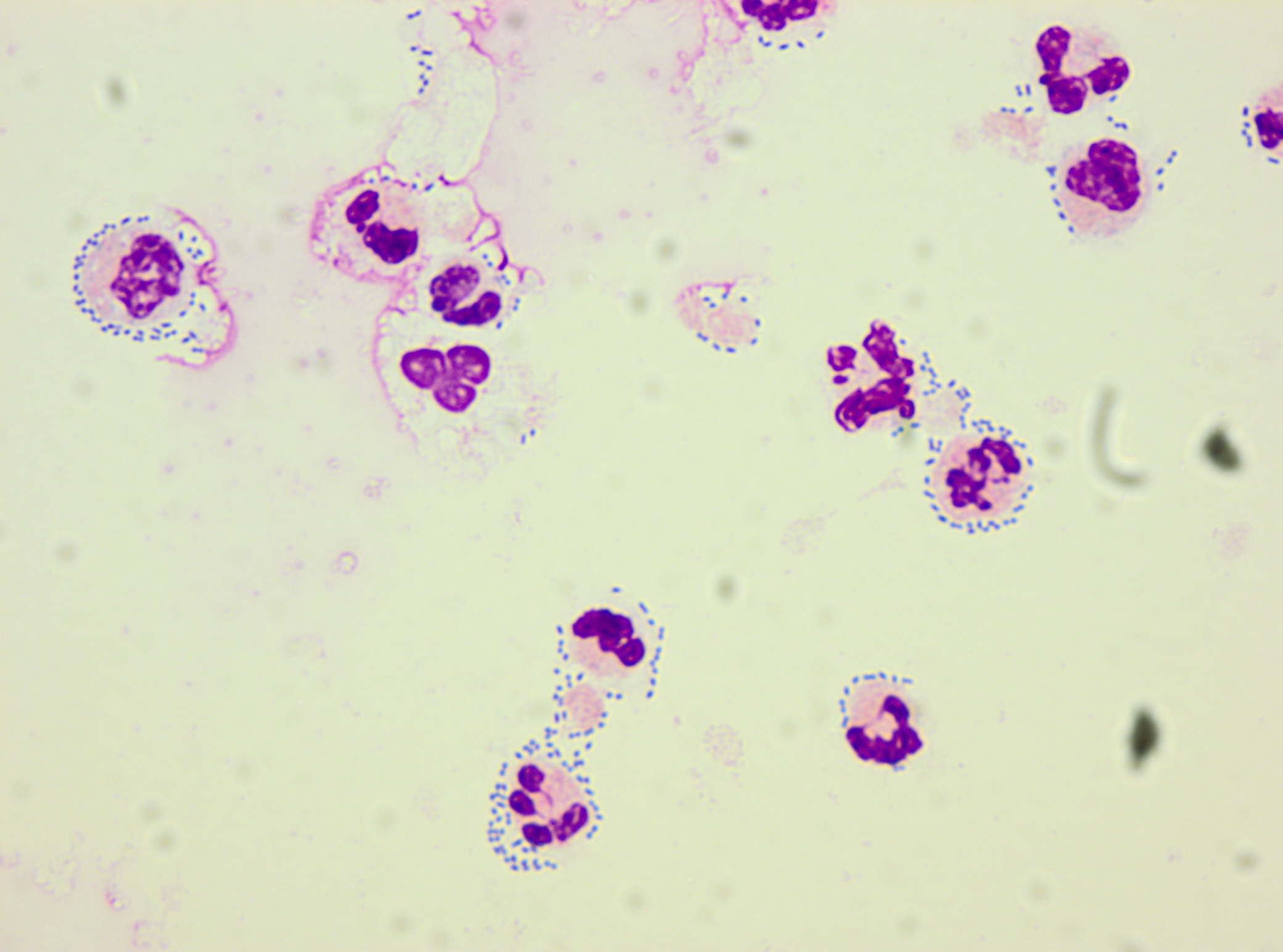 CSF with bacteriaCSF with bacteria